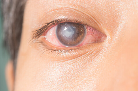 Corneal ulcer