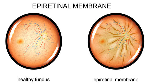 Epiretinal Membrane