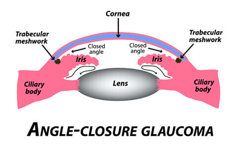 Angle closure glaucoma