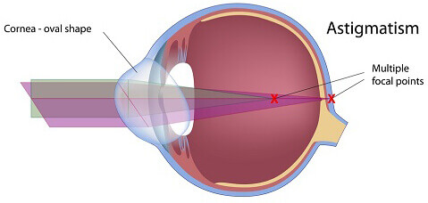 Astigmatism illustration