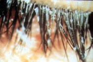 Blepharitis