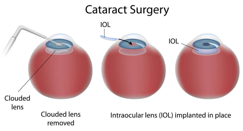 Cataract Surgery Diagram