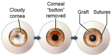 Corneal Transplant Steps