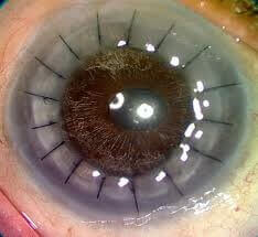 Corneal transplant image