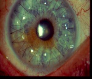 Corneal Transplant Pic