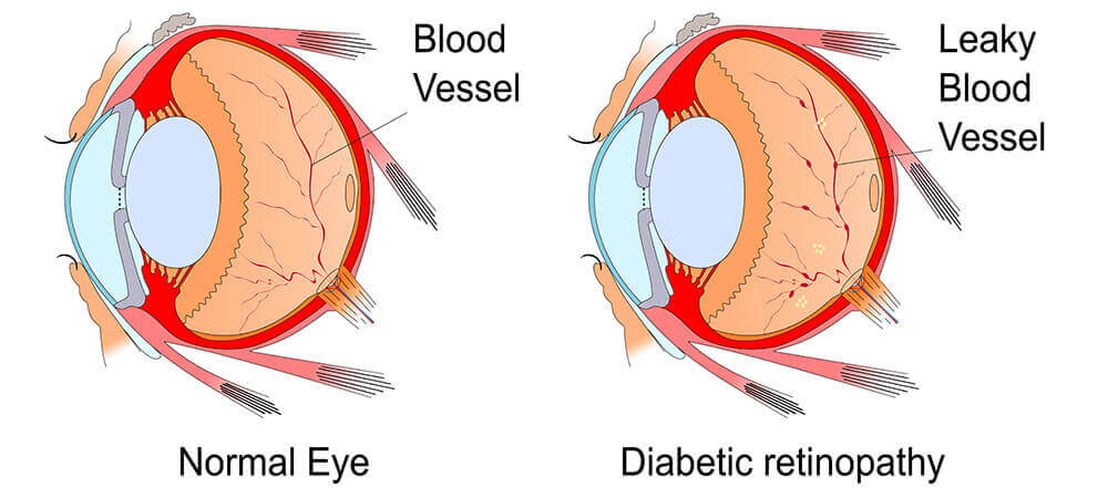 Diabetic Retinopathy diagram