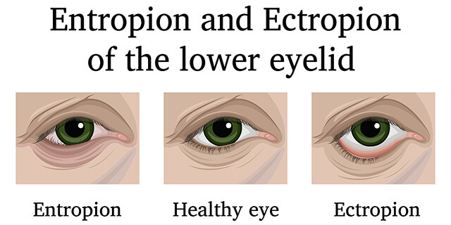 Entropion and Ectropion Eyelid diagrams