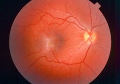 Epiretinal Membrane retinal photograph