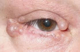Eyelid Cyst