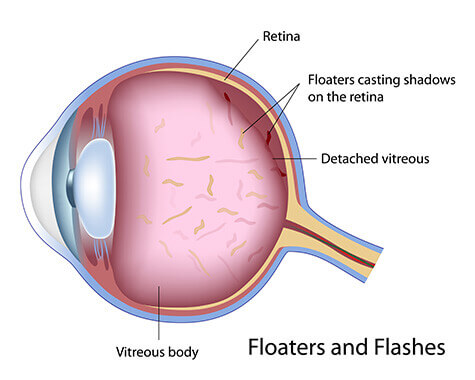 Floaters diagram