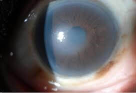 Cornea with Fuchs' Dystorphy