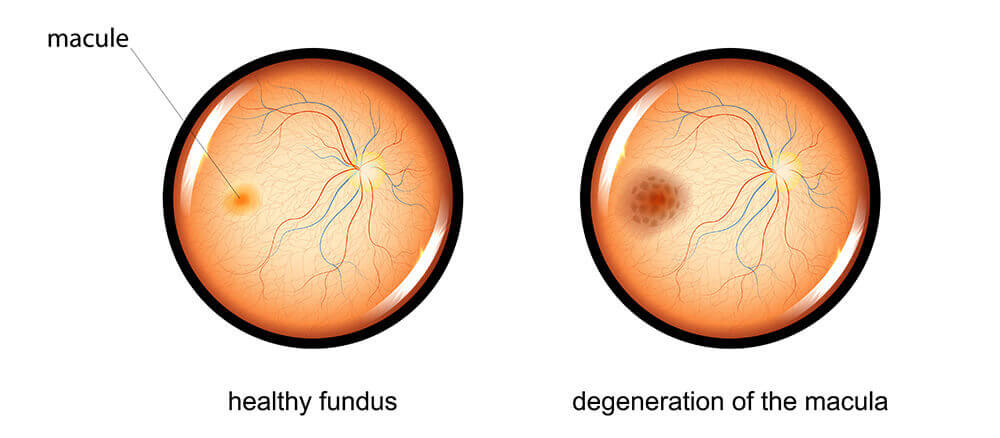 Macular degeneration diagram