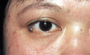 Mole on eyelid