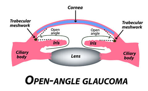 Diagram of open angle glaucoma