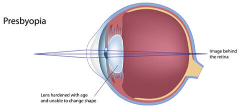 Presbyopia diagram