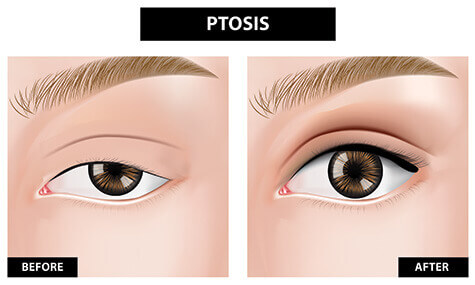 Ptosis before and after diagram