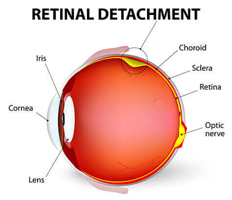 Retina detachment