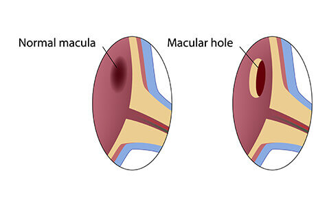 Macular hole diagram